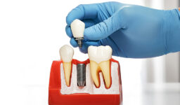 How to Select the Best Dental Implant Dentist in Winter Springs, FL